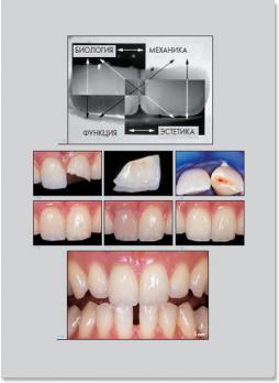 Адгезивные керамические реставрации передних зубов (Паскаль Магне (Манье), Юр Бельсер) 2015 г.